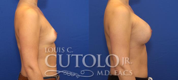 Before & After Breast Augmentation Case 137 View #5 View in Brooklyn, Staten Island, Queens, NY