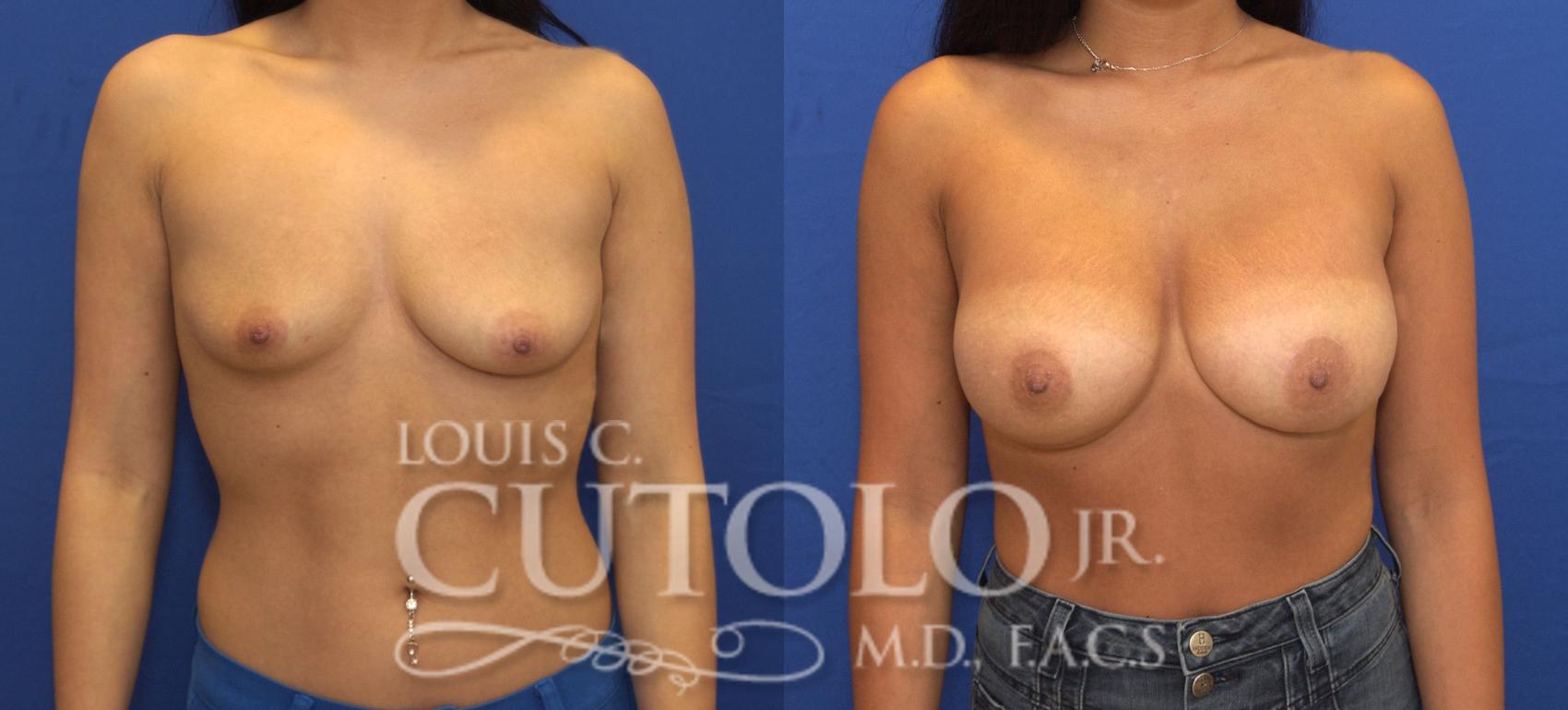 Before & After Breast Augmentation Case 140 View #1 View in Brooklyn, Staten Island, Queens, NY