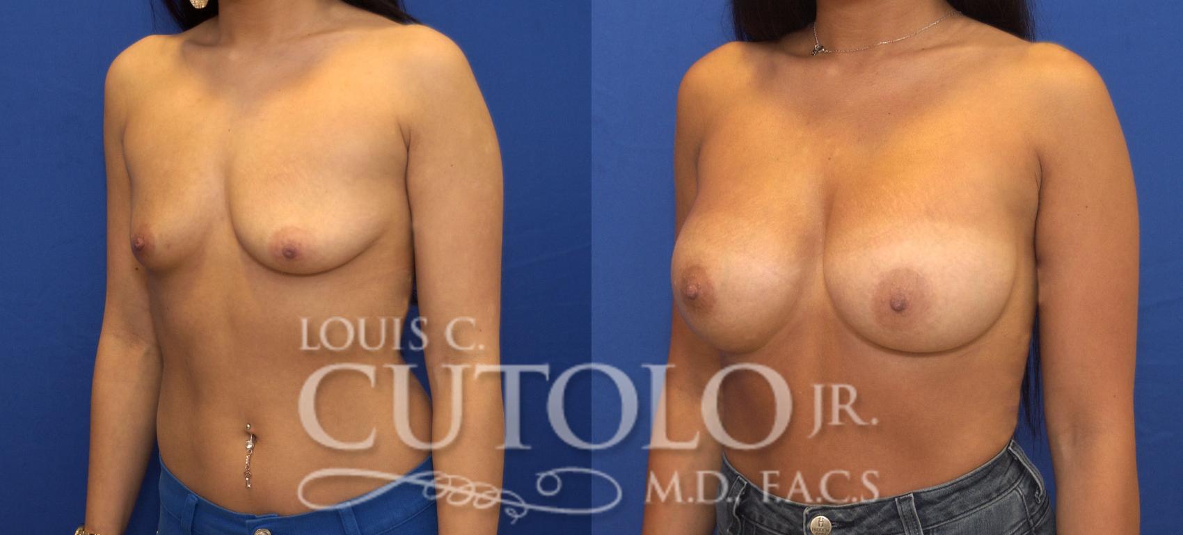 Before & After Breast Augmentation Case 140 View #2 View in Brooklyn, Staten Island, Queens, NY