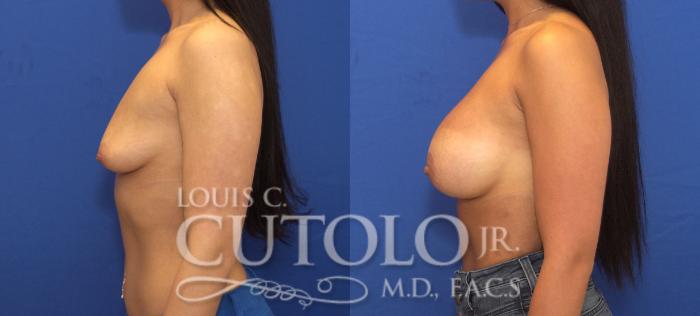 Before & After Breast Augmentation Case 140 View #3 View in Brooklyn, Staten Island, Queens, NY