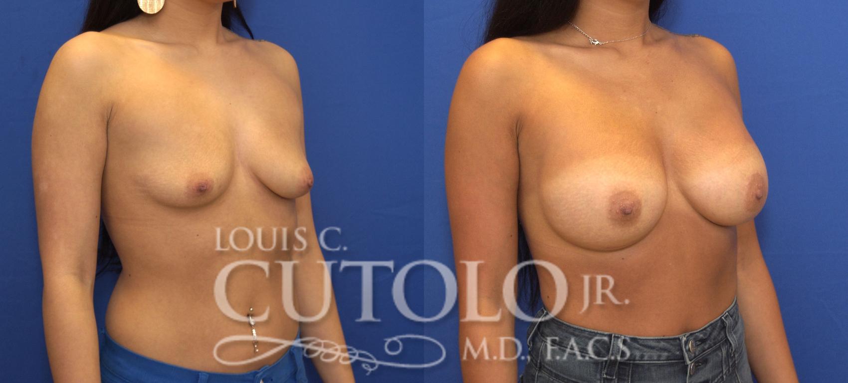 Before & After Breast Augmentation Case 140 View #4 View in Brooklyn, Staten Island, Queens, NY
