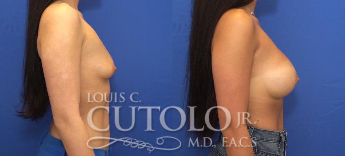 Before & After Breast Augmentation Case 140 View #5 View in Brooklyn, Staten Island, Queens, NY