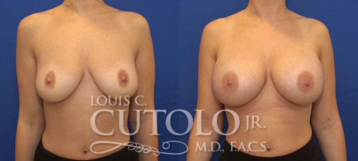 Before & After Breast Augmentation Case 141 View #1 View in Brooklyn, Staten Island, Queens, NY