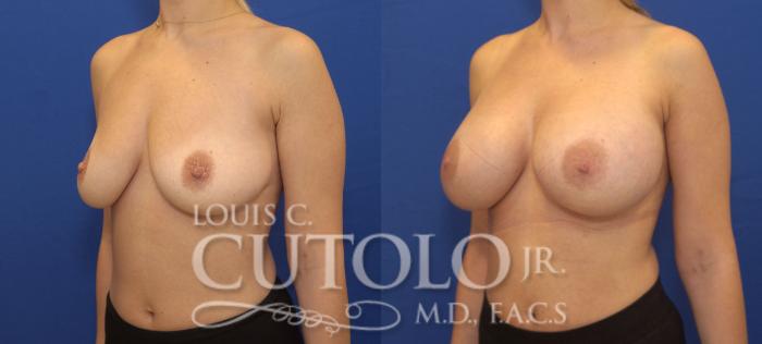 Before & After Breast Augmentation Case 141 View #2 View in Brooklyn, Staten Island, Queens, NY