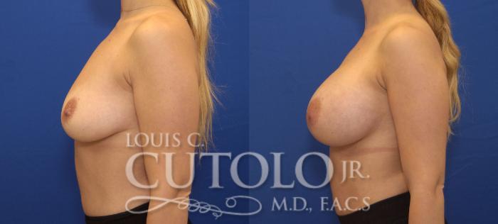 Before & After Breast Augmentation Case 141 View #3 View in Brooklyn, Staten Island, Queens, NY