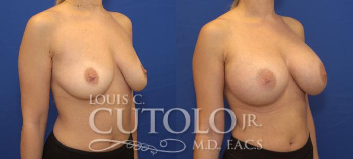 Before & After Breast Augmentation Case 141 View #4 View in Brooklyn, Staten Island, Queens, NY