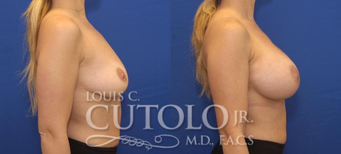 Before & After Breast Augmentation Case 141 View #5 View in Brooklyn, Staten Island, Queens, NY