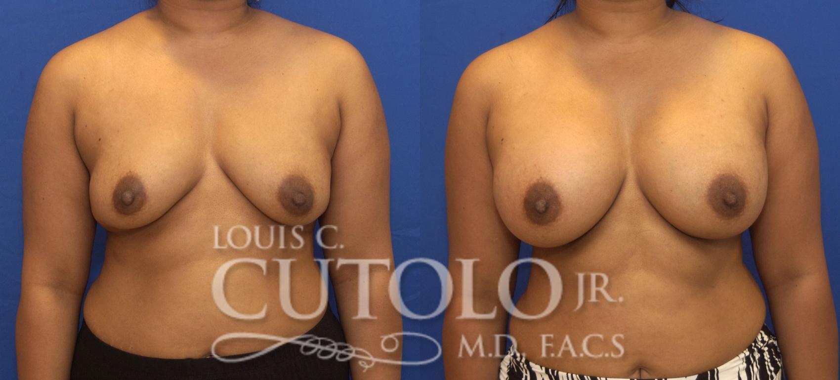 Before & After Breast Augmentation Case 145 View #1 View in Brooklyn, Staten Island, Queens, NY