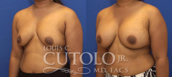 Before & After Breast Augmentation Case 145 View #2 View in Brooklyn, Staten Island, Queens, NY