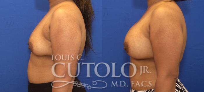 Before & After Breast Augmentation Case 145 View #3 View in Brooklyn, Staten Island, Queens, NY
