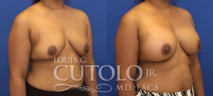 Before & After Breast Augmentation Case 145 View #4 View in Brooklyn, Staten Island, Queens, NY