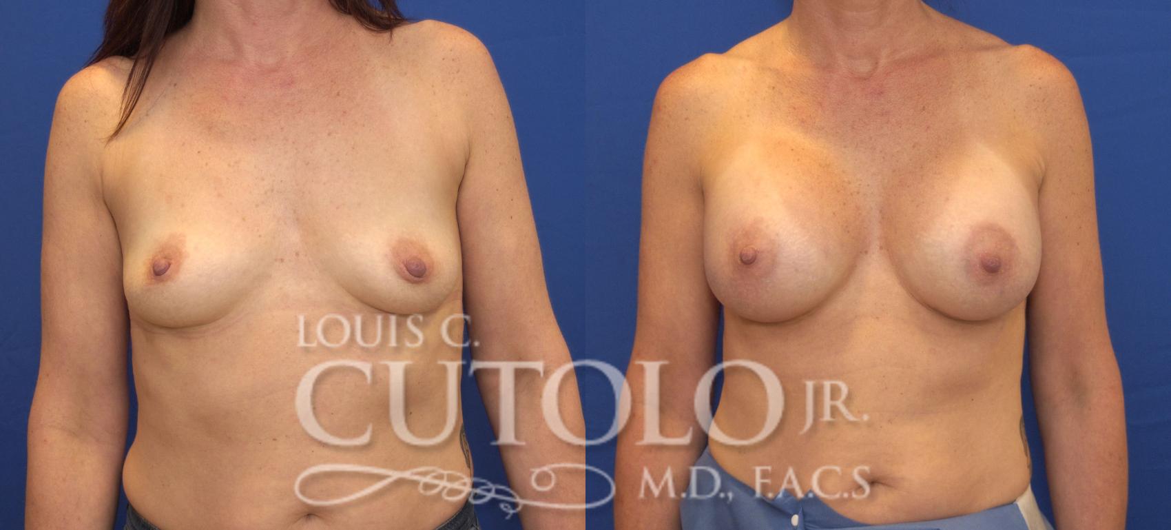 Before & After Breast Augmentation Case 146 View #1 View in Brooklyn, Staten Island, Queens, NY
