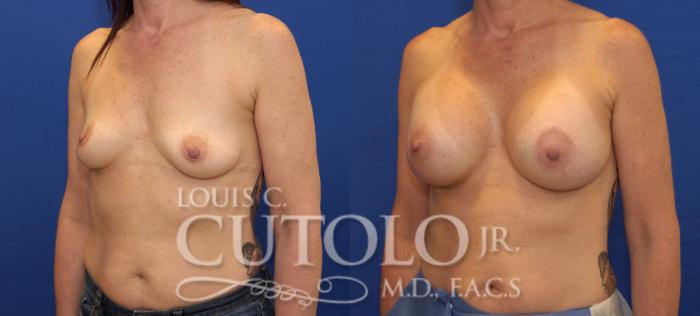 Before & After Breast Augmentation Case 146 View #2 View in Brooklyn, Staten Island, Queens, NY