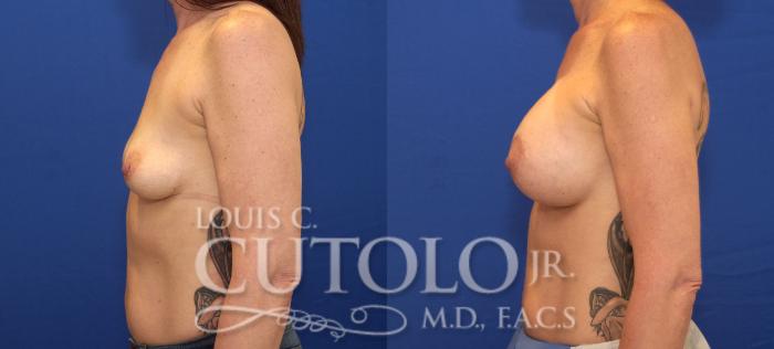 Before & After Breast Augmentation Case 146 View #3 View in Brooklyn, Staten Island, Queens, NY