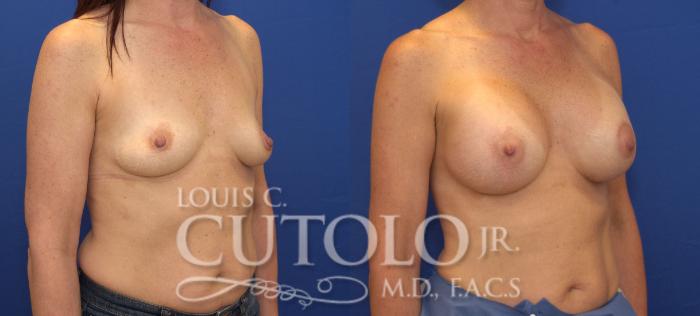 Before & After Breast Augmentation Case 146 View #4 View in Brooklyn, Staten Island, Queens, NY