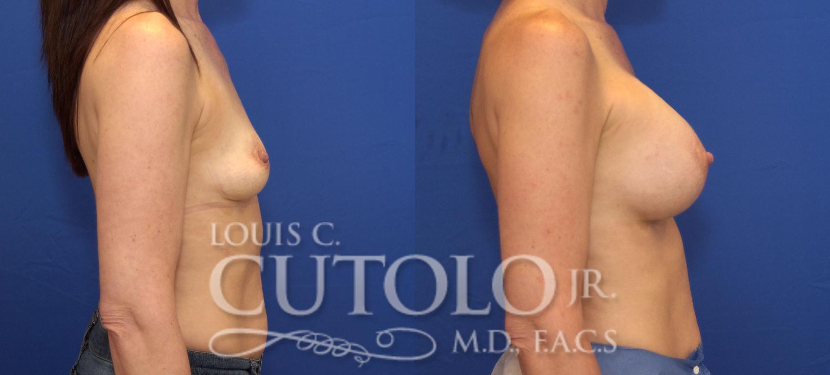 Before & After Breast Augmentation Case 146 View #5 View in Brooklyn, Staten Island, Queens, NY