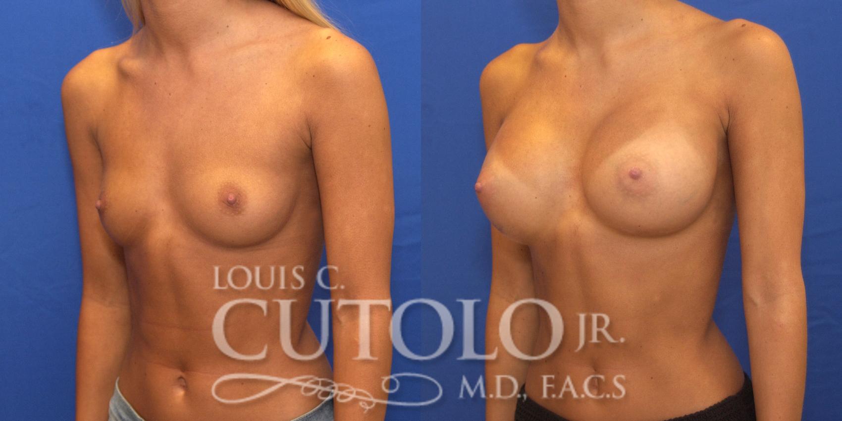 Before & After Breast Augmentation Case 147 View #2 View in Brooklyn, Staten Island, Queens, NY