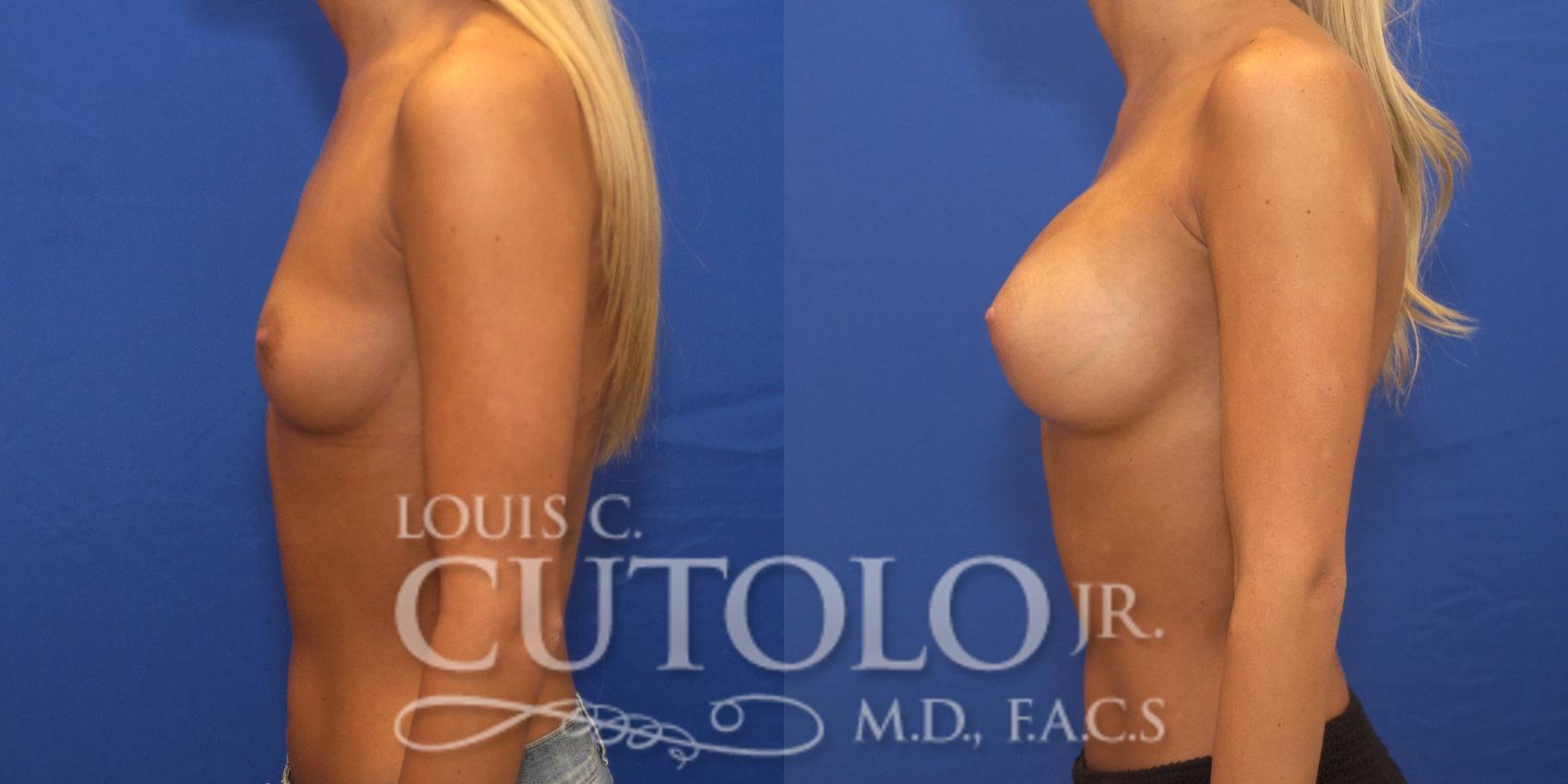 Before & After Breast Augmentation Case 147 View #3 View in Brooklyn, Staten Island, Queens, NY