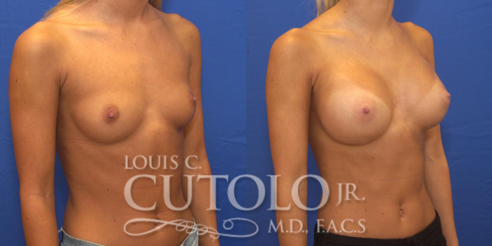 Before & After Breast Augmentation Case 147 View #4 View in Brooklyn, Staten Island, Queens, NY