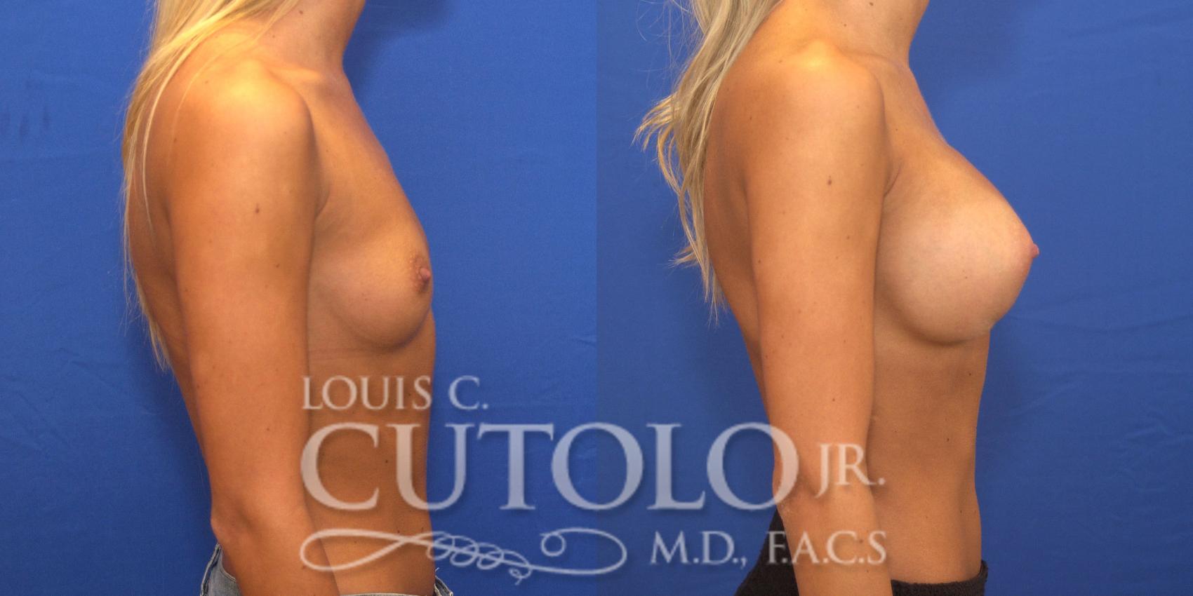 Before & After Breast Augmentation Case 147 View #5 View in Brooklyn, Staten Island, Queens, NY
