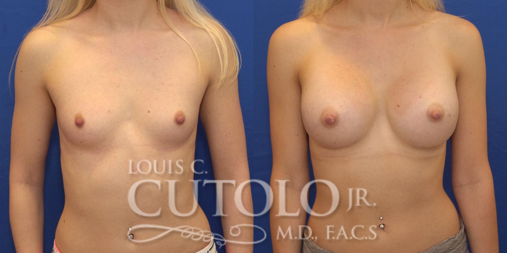 Before & After Breast Augmentation Case 152 View #1 View in Brooklyn, Staten Island, Queens, NY