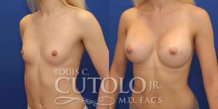 Before & After Breast Augmentation Case 152 View #2 View in Brooklyn, Staten Island, Queens, NY