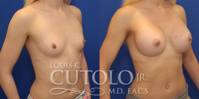 Before & After Breast Augmentation Case 152 View #4 View in Brooklyn, Staten Island, Queens, NY