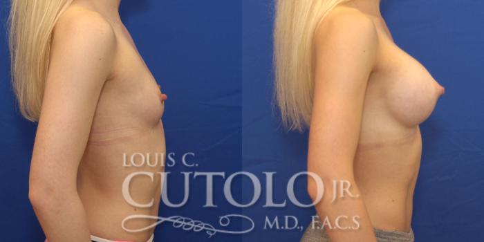 Before & After Breast Augmentation Case 152 View #5 View in Brooklyn, Staten Island, Queens, NY