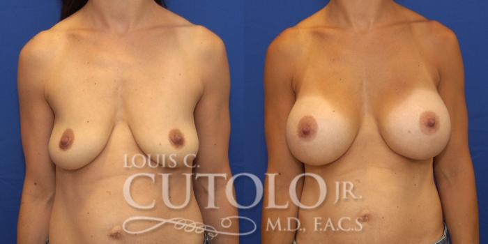 Before & After Breast Augmentation Case 155 View #1 View in Brooklyn, Staten Island, Queens, NY