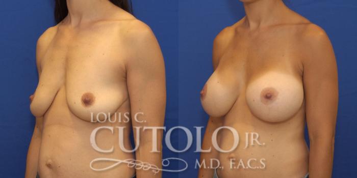 Before & After Breast Augmentation Case 155 View #2 View in Brooklyn, Staten Island, Queens, NY