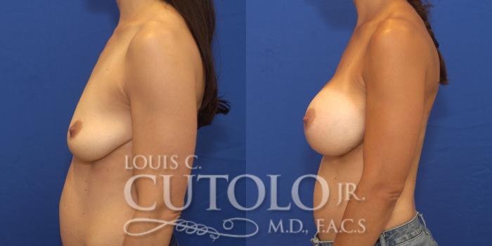 Before & After Breast Augmentation Case 155 View #3 View in Brooklyn, Staten Island, Queens, NY