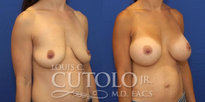 Before & After Breast Augmentation Case 155 View #4 View in Brooklyn, Staten Island, Queens, NY