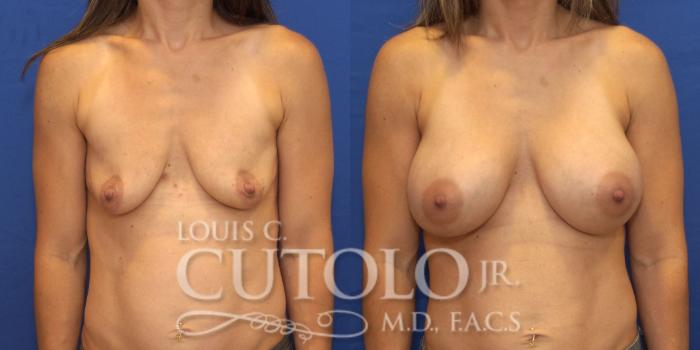 Before & After Breast Augmentation Case 156 View #1 View in Brooklyn, Staten Island, Queens, NY