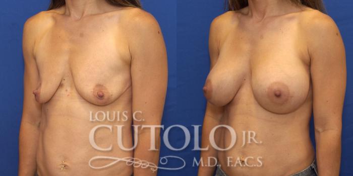 Before & After Breast Augmentation Case 156 View #2 View in Brooklyn, Staten Island, Queens, NY