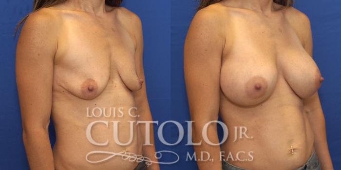 Before & After Breast Augmentation Case 156 View #4 View in Brooklyn, Staten Island, Queens, NY