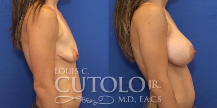 Before & After Breast Augmentation Case 156 View #5 View in Brooklyn, Staten Island, Queens, NY