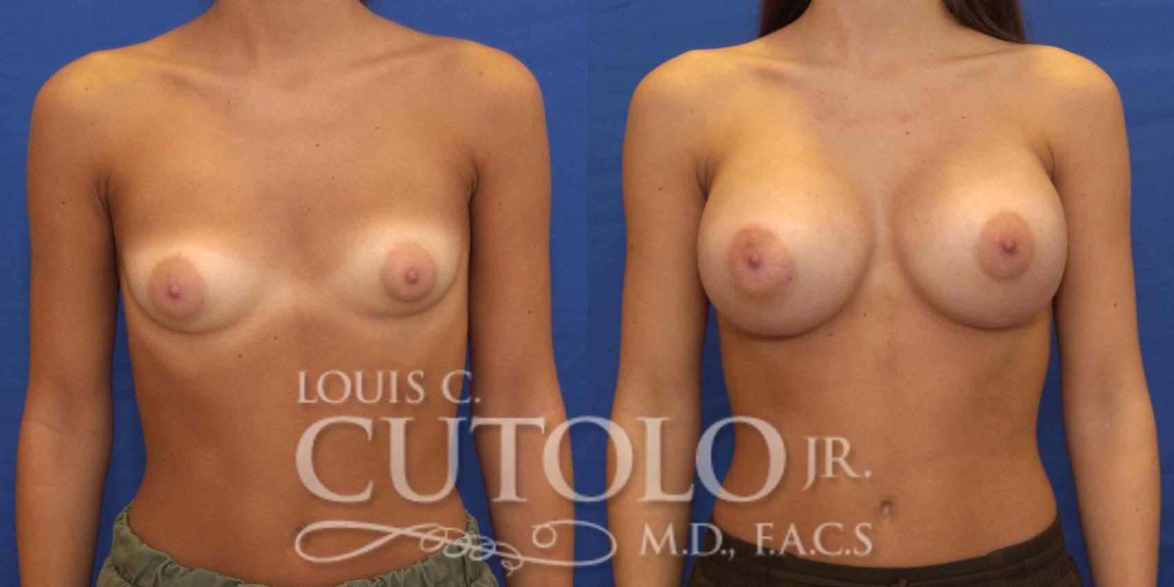 Before & After Breast Augmentation Case 159 View #1 View in Brooklyn, Staten Island, Queens, NY