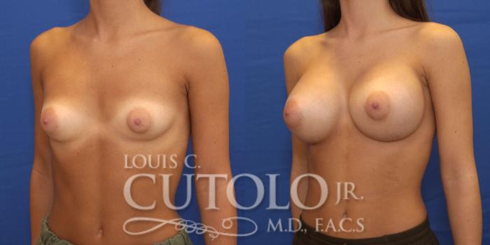 Before & After Breast Augmentation Case 159 View #2 View in Brooklyn, Staten Island, Queens, NY
