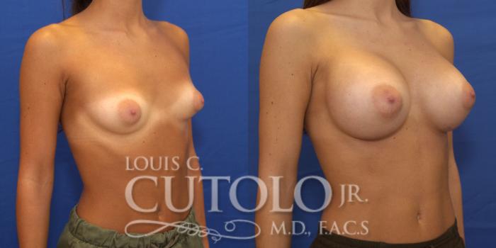 Before & After Breast Augmentation Case 159 View #4 View in Brooklyn, Staten Island, Queens, NY