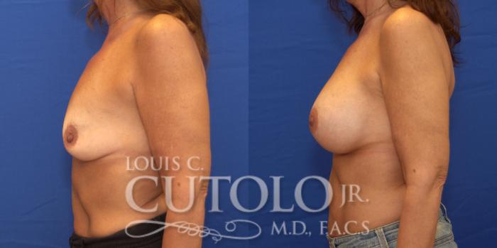 Before & After Breast Augmentation Case 160 View #3 View in Brooklyn, Staten Island, Queens, NY