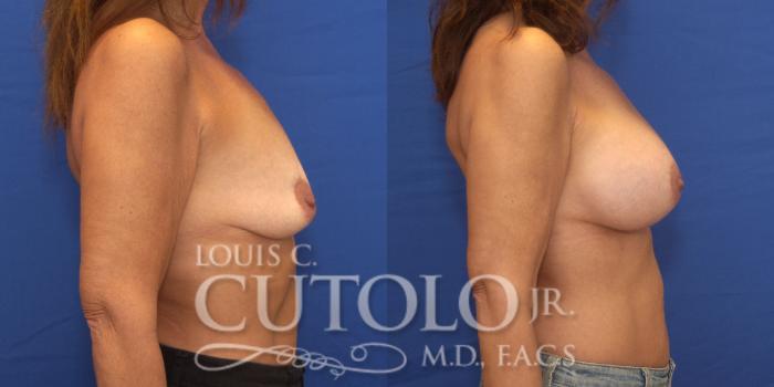 Before & After Breast Augmentation Case 160 View #5 View in Brooklyn, Staten Island, Queens, NY
