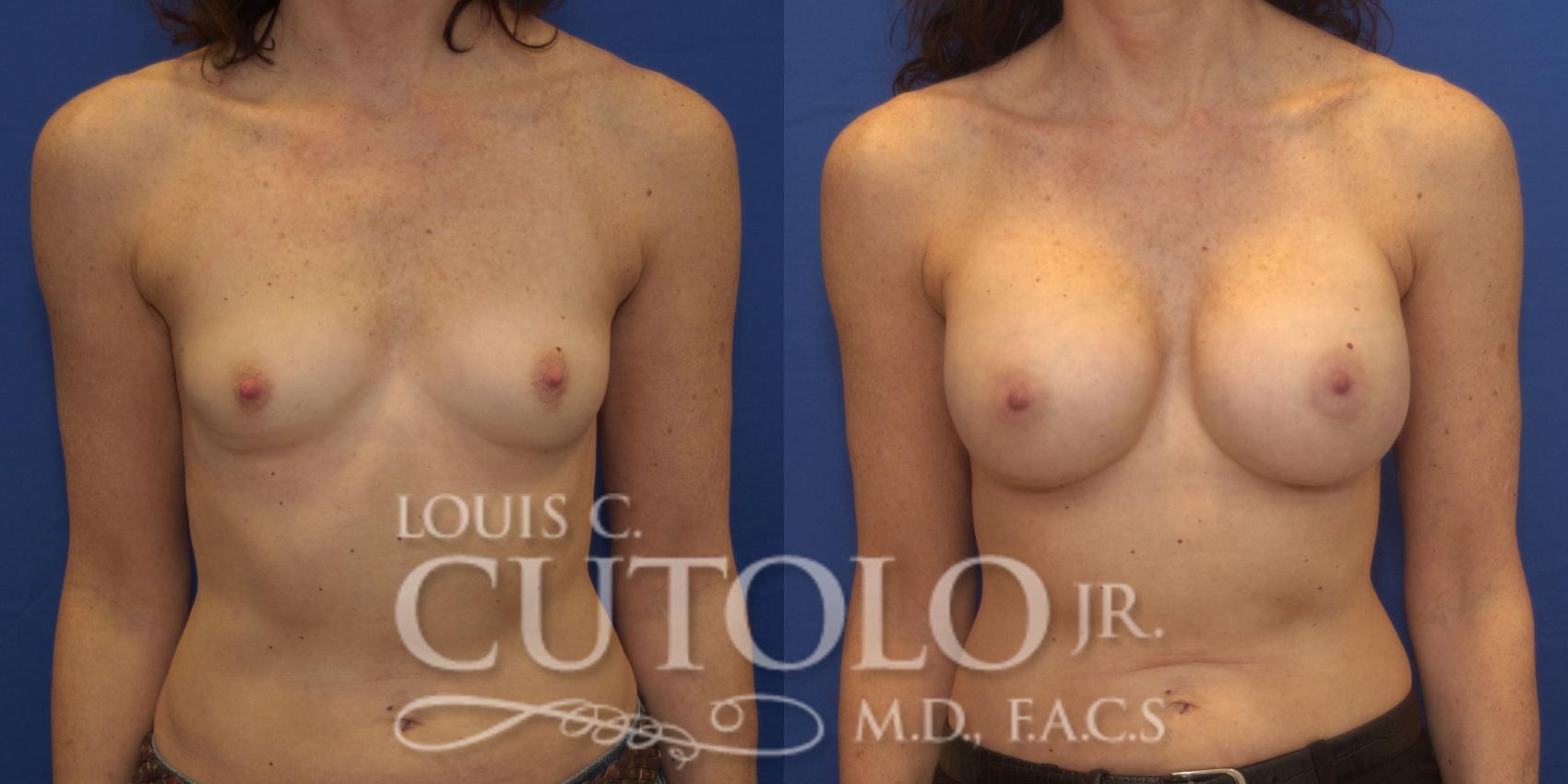 Before & After Breast Augmentation Case 162 View #1 View in Brooklyn, Staten Island, Queens, NY