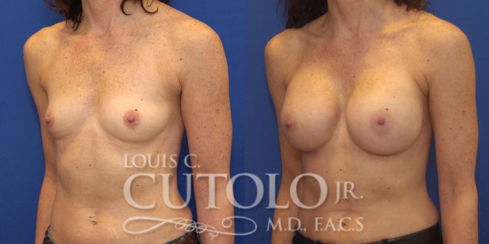 Before & After Breast Augmentation Case 162 View #2 View in Brooklyn, Staten Island, Queens, NY