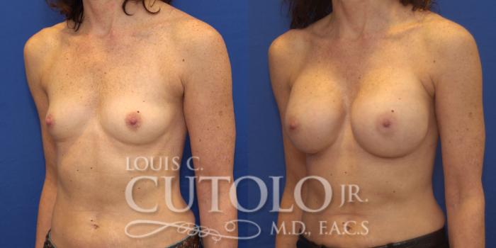 Before & After Breast Augmentation Case 162 View #2 View in Brooklyn, Staten Island, Queens, NY