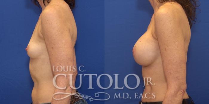 Before & After Breast Augmentation Case 162 View #3 View in Brooklyn, Staten Island, Queens, NY