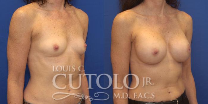 Before & After Breast Augmentation Case 162 View #4 View in Brooklyn, Staten Island, Queens, NY