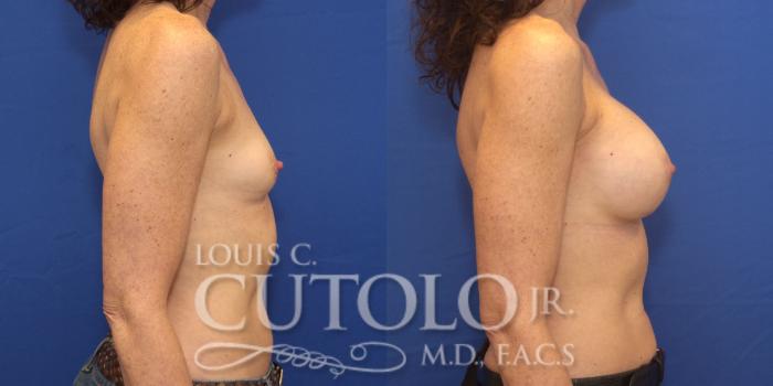 Before & After Breast Augmentation Case 162 View #5 View in Brooklyn, Staten Island, Queens, NY