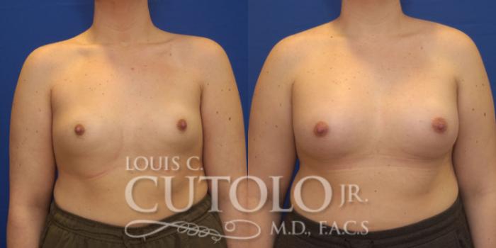 Before & After Breast Augmentation Case 164 View #1 View in Brooklyn, Staten Island, Queens, NY