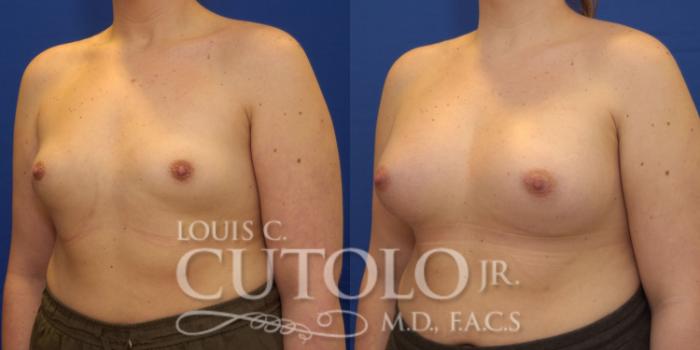 Before & After Breast Augmentation Case 164 View #2 View in Brooklyn, Staten Island, Queens, NY