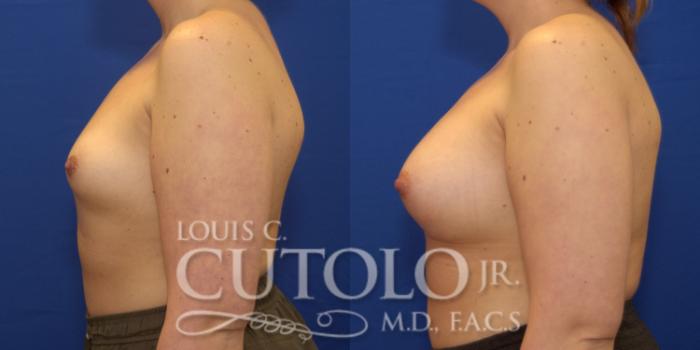 Before & After Breast Augmentation Case 164 View #3 View in Brooklyn, Staten Island, Queens, NY